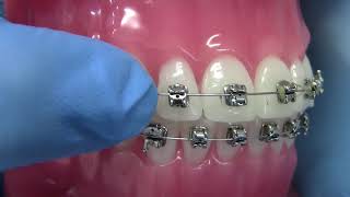 How to Manage a Open Bracket Orthodontic emergency [upl. by Secor]