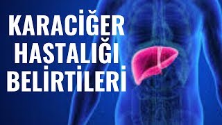 Karaciğer HastalıIğı Belirtileri Nedenleri Serdar Akgün Sağlıklı Yaşam [upl. by Ecerahc]