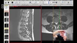 Clinical Series How to See a Pinched Nerve Foraminal Stenosis on MRI [upl. by Lutero612]