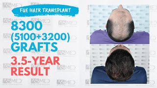 Manual FUE Hair Transplant 8300 51003200 Grafts 35Year Result  ASMED  Dr Koray Erdogan [upl. by Ariec]