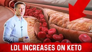 Cardiologist Dr Nadir Ali Explains LDL Bad Cholesterol Spike With Keto – DrBerg [upl. by Rosenberger]