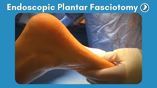 Causes of Plantar Fasciitis [upl. by Nerty]