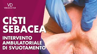 CISTI SEBACEA intervento ambulatoriale di svuotamento [upl. by Glanti]