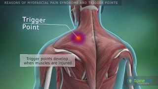 Myofascial pain syndrome and trigger points Reasons [upl. by Gora37]