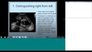 Fetal Echocardiography Basic Views by Dr Sejal Shah [upl. by Anala590]