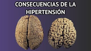 CONSECUENCIAS Y PELIGROS DE LA HIPERTENSIÓN  demencia problemas renales infarto ceguera [upl. by Iorio]