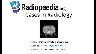 Pleomorphic sarcomatoid carcinoma Radiopaediaorg Cases in Radiology [upl. by Orvan]