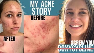 Acne Antibiotics DOXYCYCLINE MAKES ACNE WORSE  My Acne Story BEFORE amp AFTER with PICTURE TIMELINE [upl. by Daveta]