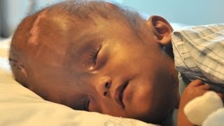 Swollen Head Baby Leaves Hospital After Successful Surgery [upl. by Noryv]