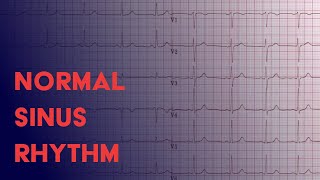 Normal Sinus Rhythm  EKG ECG Interpretation [upl. by Yerak590]