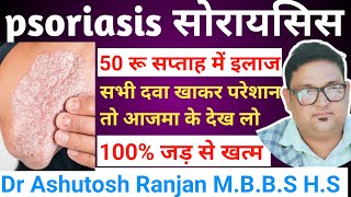 psoriasis ka ilaj 👉सोरायसिस को जड़ से खत्म करें 👉50 रुपये में👉क्यों नहीं ठीक होगा 💯 ठीक होगा [upl. by Greenwood105]