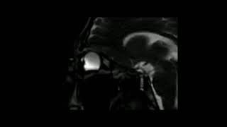 Keratoconus Eye rubbing MRI Keratocone frottements oculaires IRM [upl. by Notlew]