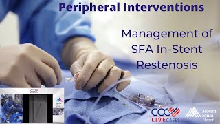 Management of SFA InStent Restenosis [upl. by Sherilyn447]