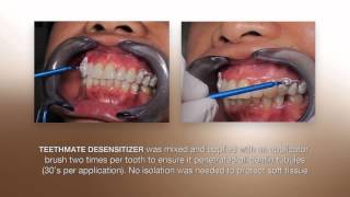 Desensitizing Procedure using the NEW TEETHMATE DESENSITIZER from Kuraray [upl. by Aerdnaxela871]