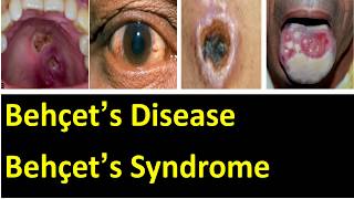 Behçet’s disease  behçet’s syndrome cause symptoms pathology diagnosis and treatment [upl. by Astrix223]