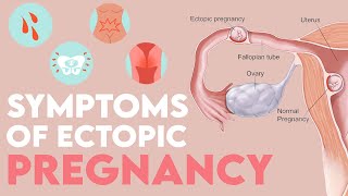 HEAVY SIGNS And SYMPTOMS Of ECTOPIC Pregnancy MOMMATTERS [upl. by Sawyer849]