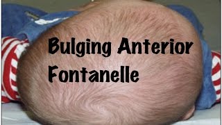 Quick Pediatrics Causes for Bulging of Anterior Fontanelle [upl. by Thedric]