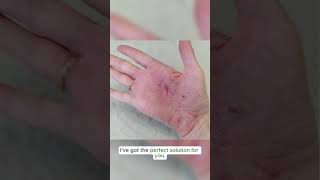 Hand eczema requires deep moisturization Try this Zudaifu 3rd generation eczema zudaifu [upl. by Simeon]