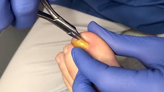 Usuwanie wrastającego fragmentu paznokcia  Ingrown toenail removal [upl. by Darill]