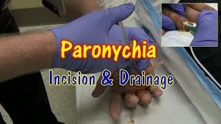 Paronychia Incision and Drainage [upl. by Orecul]