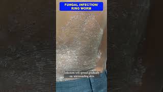 Fungal infection  By Dr Uttam Kumar Lenka MBBS MD Consultant Dermatologist [upl. by Bartholomew]