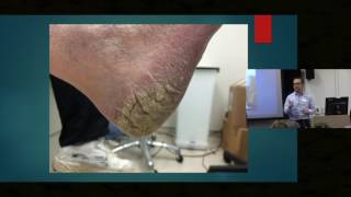 Itch in Elderly Skin  Dr Ian Bekker [upl. by Maddocks]