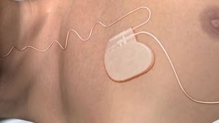 New sleep apnea device gets FDA approval [upl. by Conrad233]