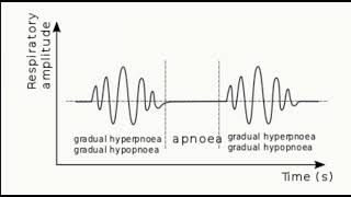 Cheyne stokes breathing in a patient with heart failure [upl. by Tove]