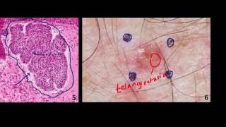 Introduction to NMSC Skin Cancer 2 Basal Cell Cancer BCC and Squamous Cell Cancer SCC [upl. by Fabrin]