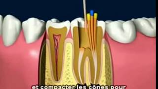 Le traitement de canal dentaire Clinique Dentaire Orozen [upl. by Orlan]