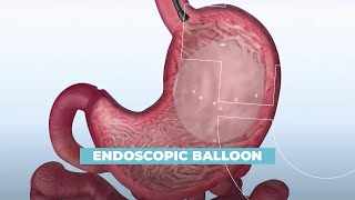 Endoscopic Intragastric Balloon  Mayo Clinic [upl. by Galatea989]