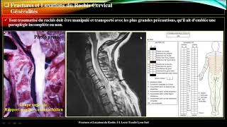 Traumatisme du rachis cervical 🤩 meilleure explication 🤩 par Pr Atia [upl. by Thomson]