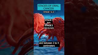 Understanding the Stages of Oral Cancer Diagnosis and Treatment 🎗️👄 OralCancer cancerstages [upl. by Tiraj]