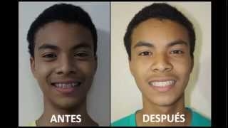 ORTODONCIA ANTES Y DESPUÉSPACIENTE CON DIASTEMA By DR JAVIER TOMALÁ ROSALES [upl. by Airamat]