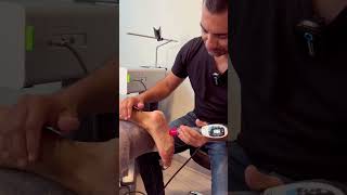 SHOCKWAVE THERAPY  PLANTAR FASCIA [upl. by Airahcaz506]