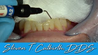 Bonding Incisal Edges of Anterior Teeth  Dental Minute with Dr Steven T Cutbirth DDS [upl. by Suirtemed]