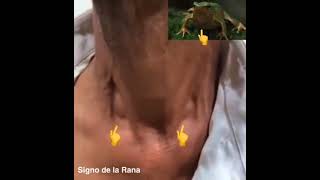 Signo de la rana [upl. by Nottap]