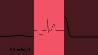 Hyperkalemia ECG Findings  Shorts [upl. by Eirojam]