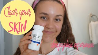 How To Get Rid of Acne  My Doxycycline Experience [upl. by Yadsendew563]