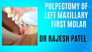 PULPECTOMY OF LEFT MAXILLARY SECOND MOLAR TEETH [upl. by Ainehs233]