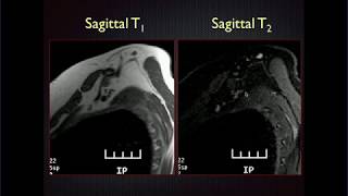 MRI of the Brachial Plexus [upl. by Quint45]