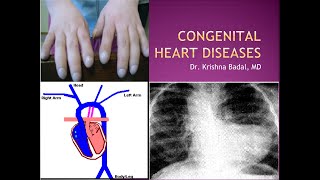 Congenital heart diseases [upl. by Notned75]