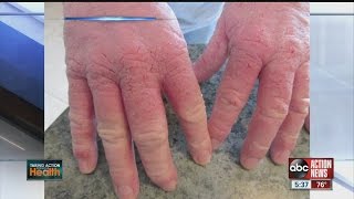 Atopic Dermatitis eczema From the Inside Out [upl. by Flam342]