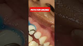 Protection gingivale pour le blanchiment des dents [upl. by Murial]