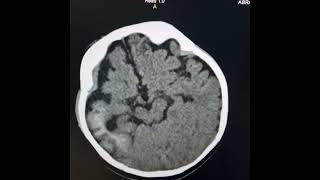 Encepalofacial angiomatosisSturge  Weber syndrome [upl. by Nnorahs996]