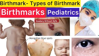 Pediatrics  Birthmarks  Types of Birthmarks  Stroke Spot  Milia Spot  Strawberry Spot  Pedia [upl. by Acisseg]