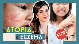 ✦ Piel ATÓPICA o eccema en BEBÉS y NIÑOS Cuidados y tratamiento del brote de dermatitis atópica [upl. by Bijan]