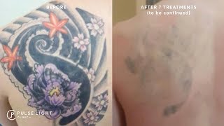 Laser Tattoo Removal  Before and Afters Gallery [upl. by Hsital]