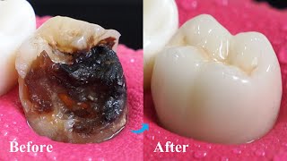 Incredible Restoration Of Tooth By Root Canal And Zirconia Crown [upl. by Clarette]