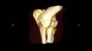 3D elbow dog ct corronoideal process wwwctinvetcom [upl. by Llekcm]